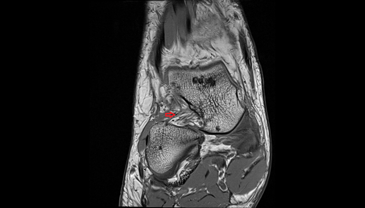 lateral talocalcaneal ligament  sag cross sectional anatomy 3T MRI AI enhanced radiology image-img-00000-00000_00001