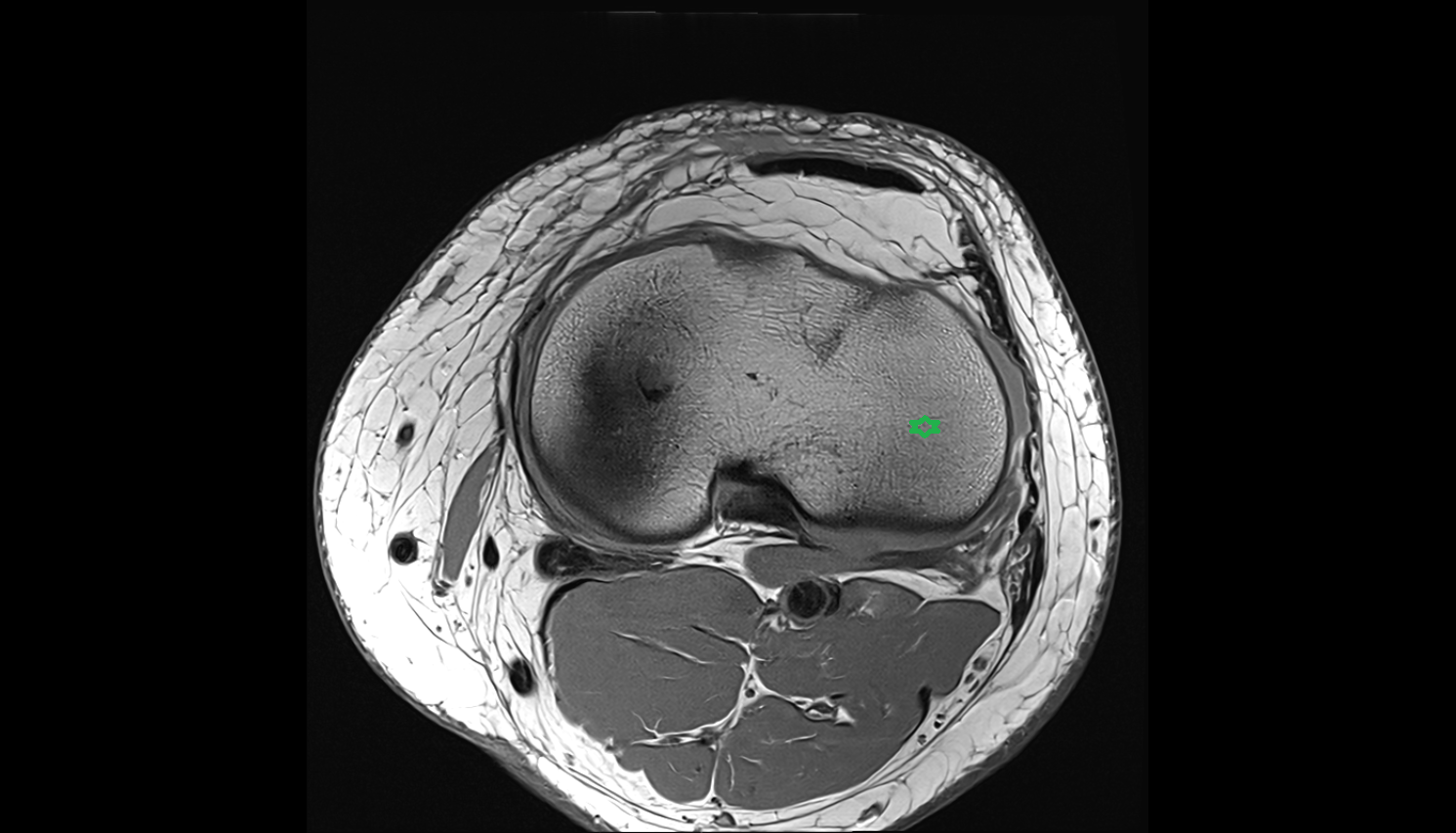 lateral tibial plateau  axial cross sectional anatomy 3T MRI AI enhanced  radiology  anatomy image-img-00000-00000