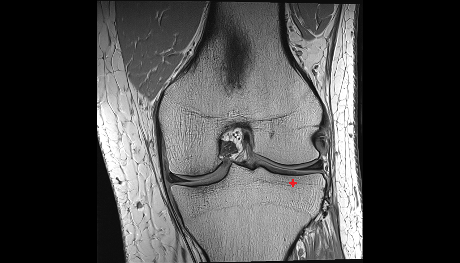 lateral tibial plateau  coronal cross sectional anatomy 3T MRI AI enhanced  radiology  anatomy image-img-00000-00000