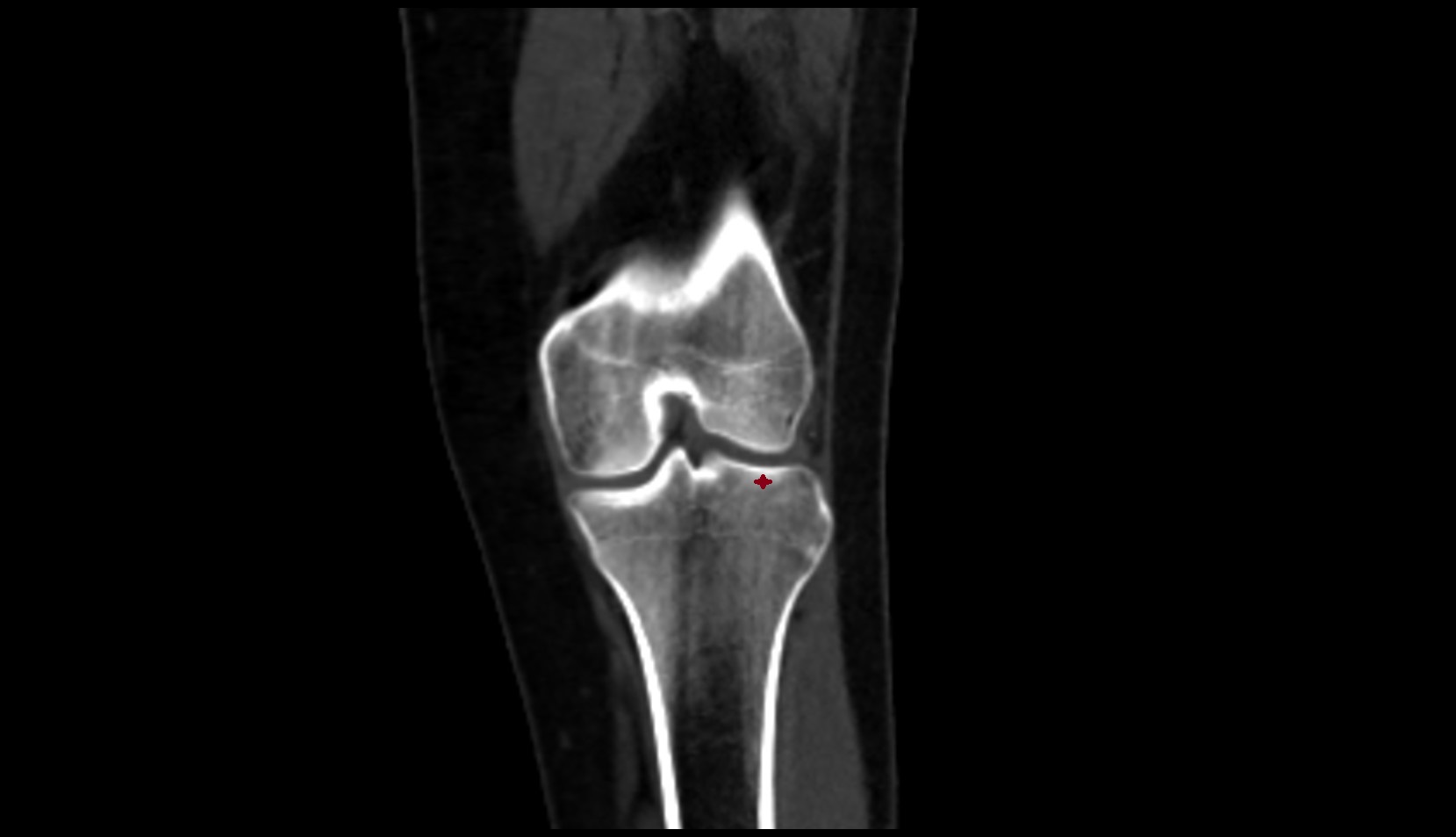 lateral tibial plateau ct coronal image