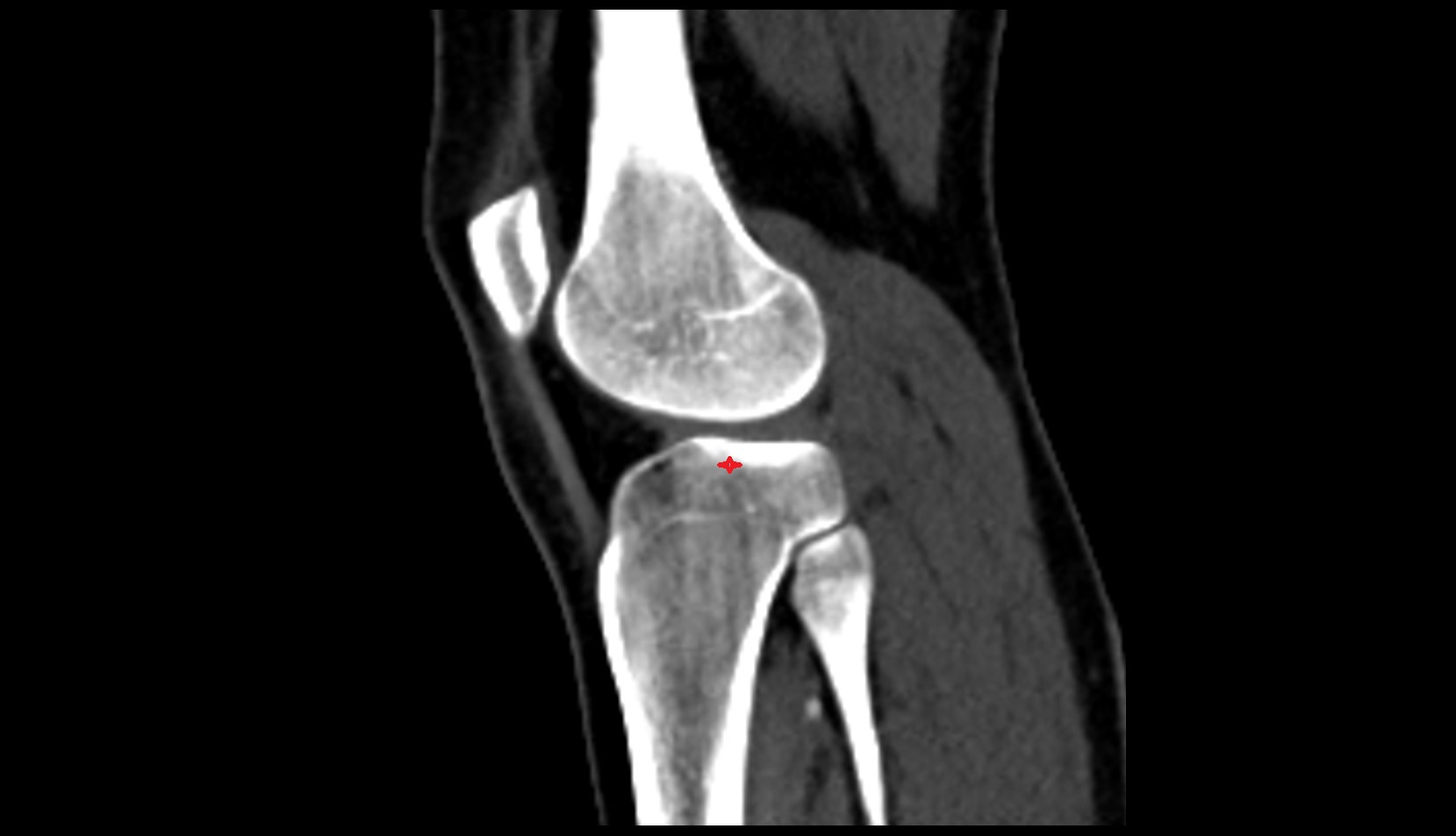 lateral tibial plateau ct sag image