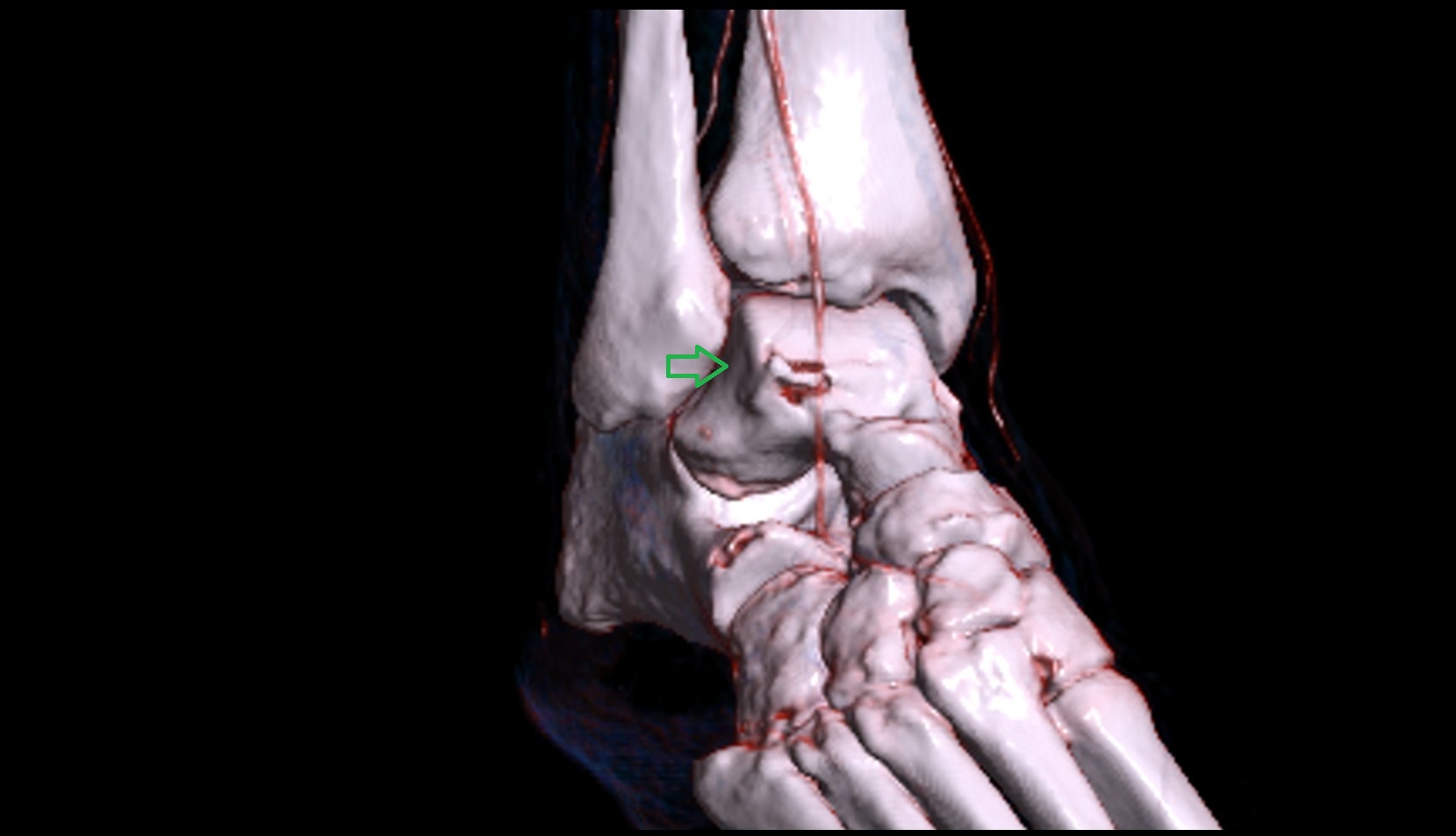 Lateral malleolar facet of talus 3d