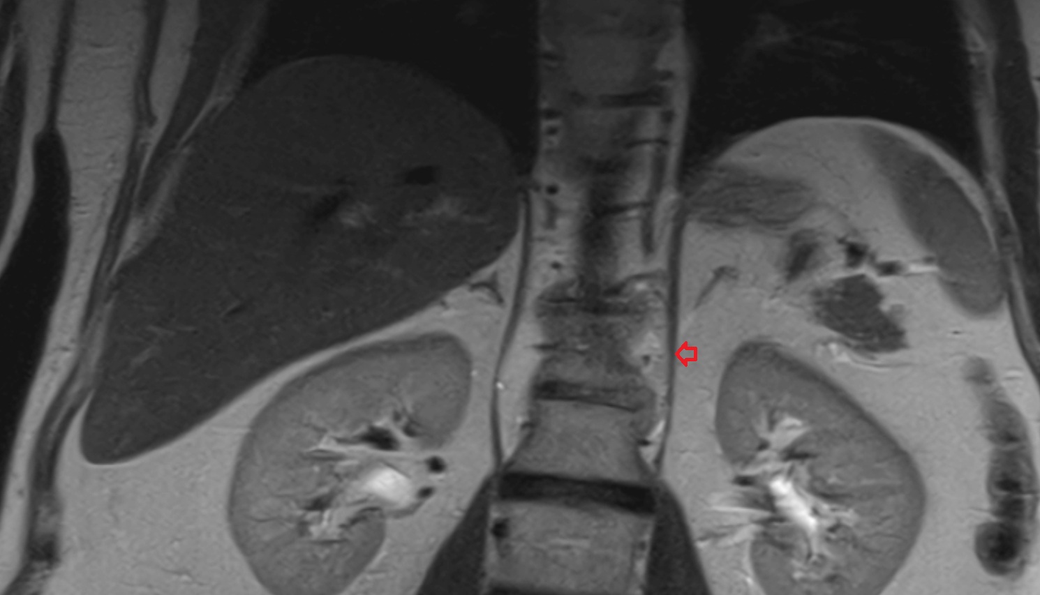left lumbar part of diaphragm  mri coronal   anatomy  image-img-00000-00000