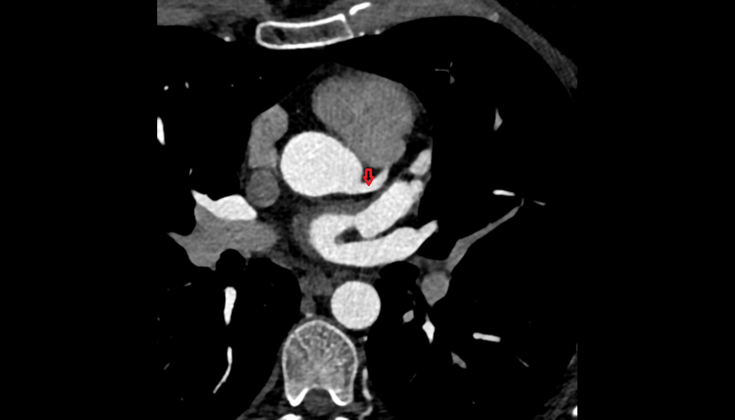 left main coronary artery (LMCA)   anantomy  CT  axial image -img-00000-00000