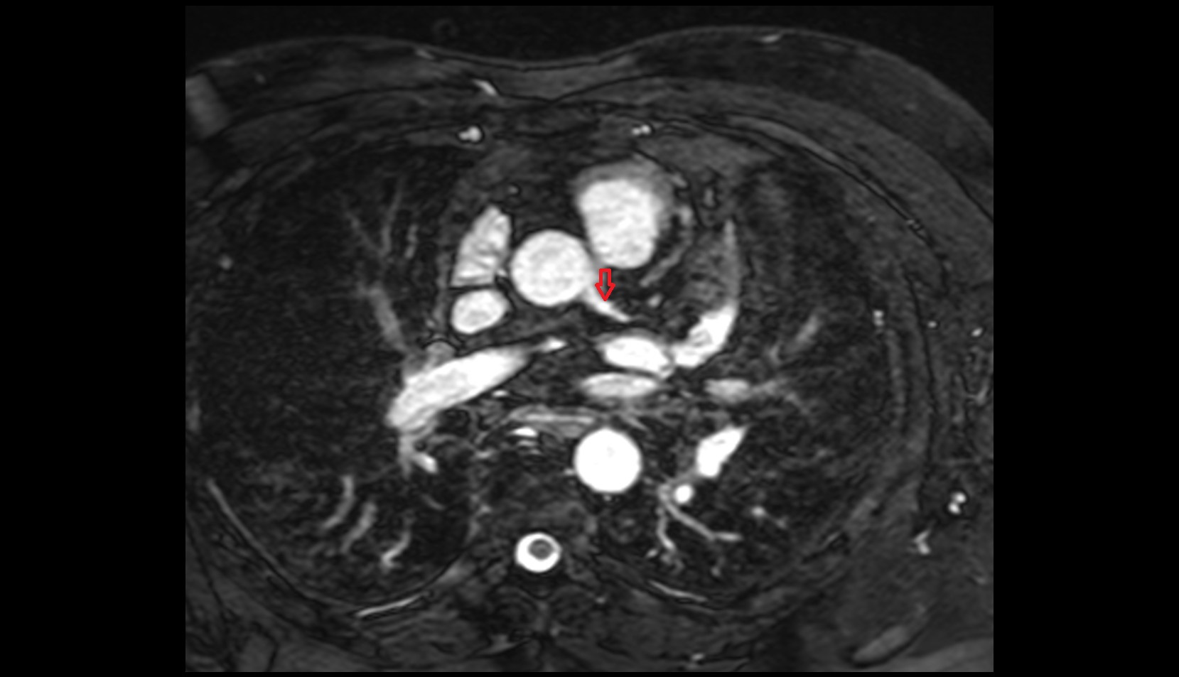 left main coronary artery (LMCA) mri axial image
