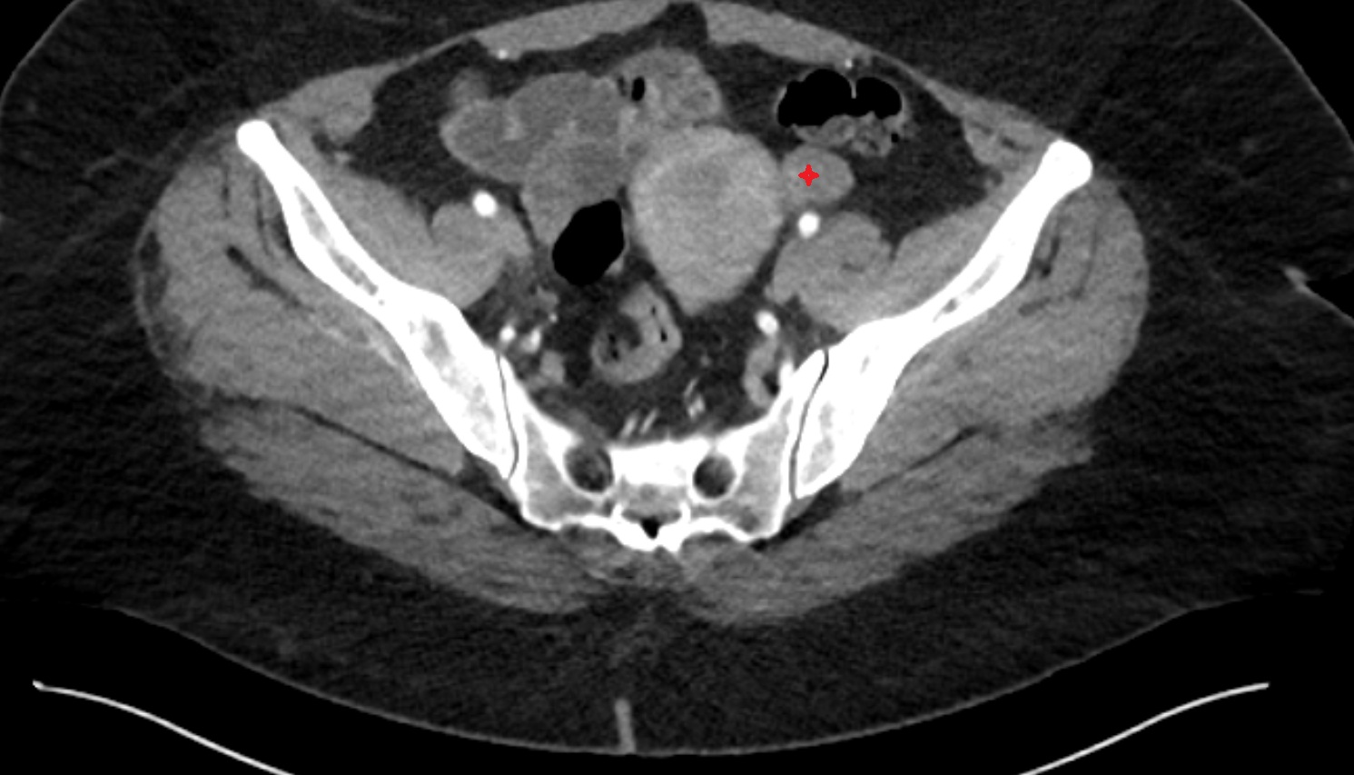 left  ovary ct  axial  image anatomy  image-img-00000-00000