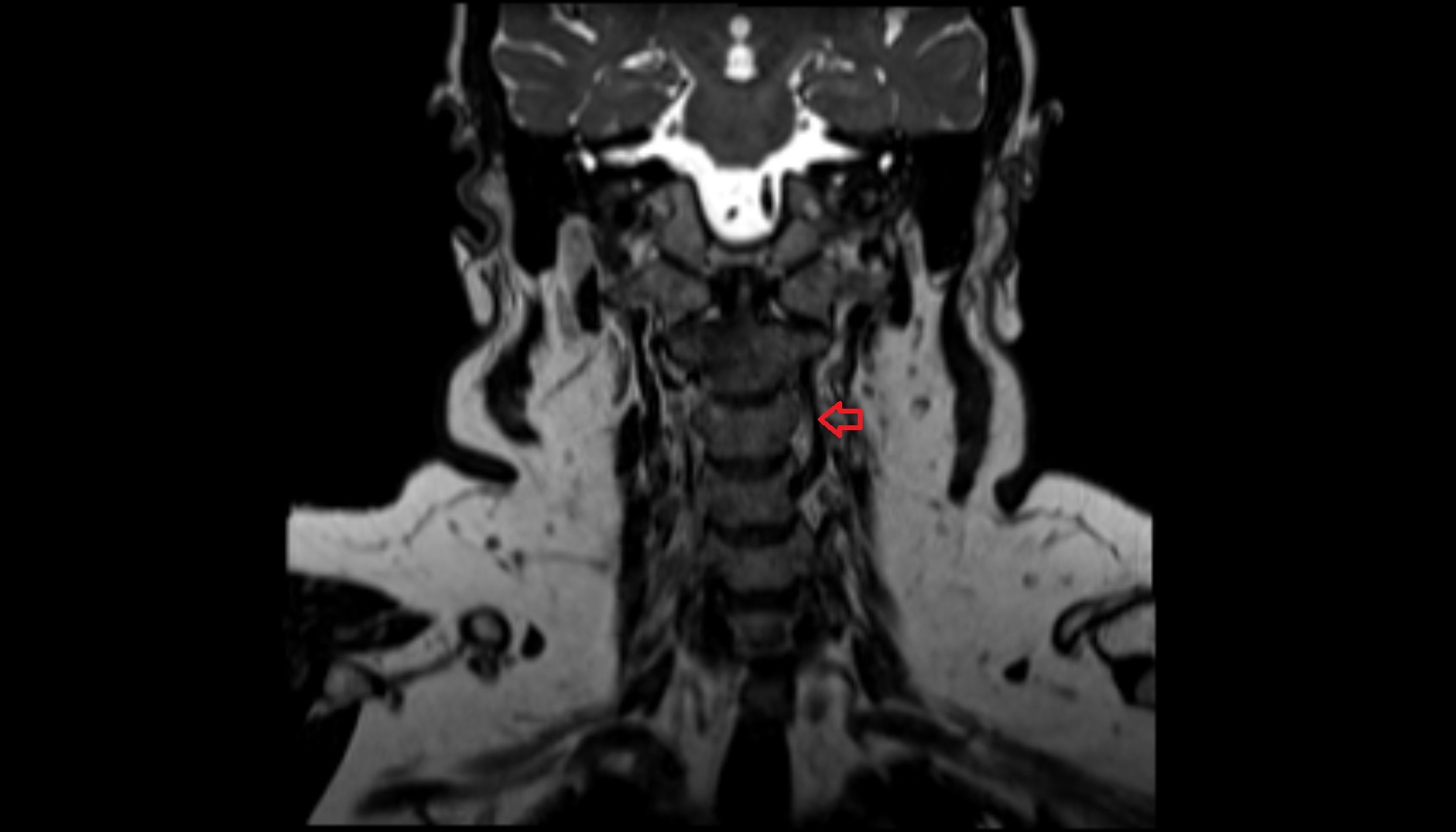 left vertebral artery  mri coronal image -img-00000-00000