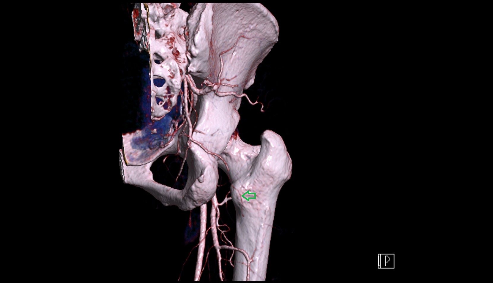 lesser trochanter 3D CT VRT anatomy  image