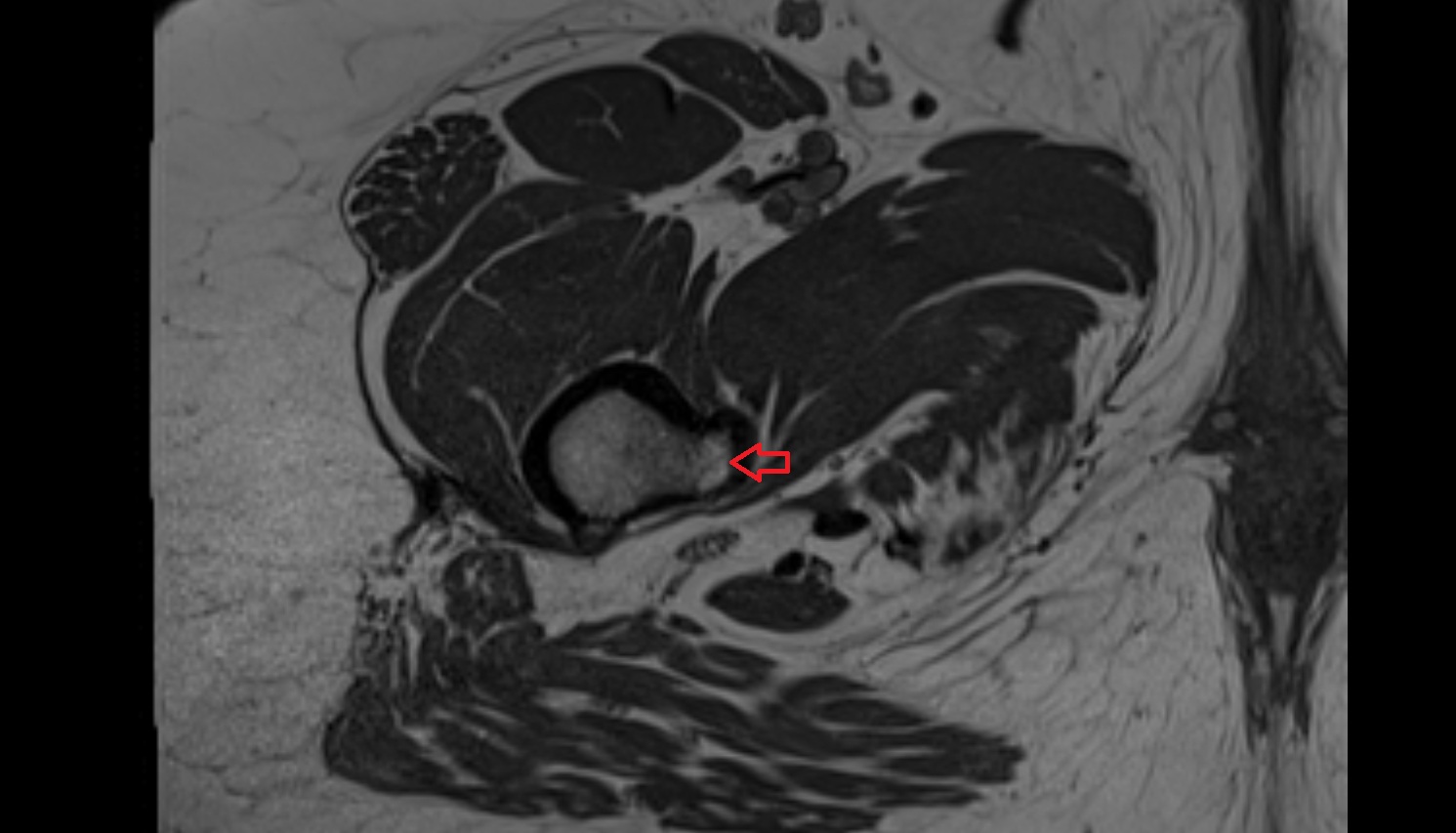 lesser trochanter  MRI  axial  anatomy  image-img-00000-00000