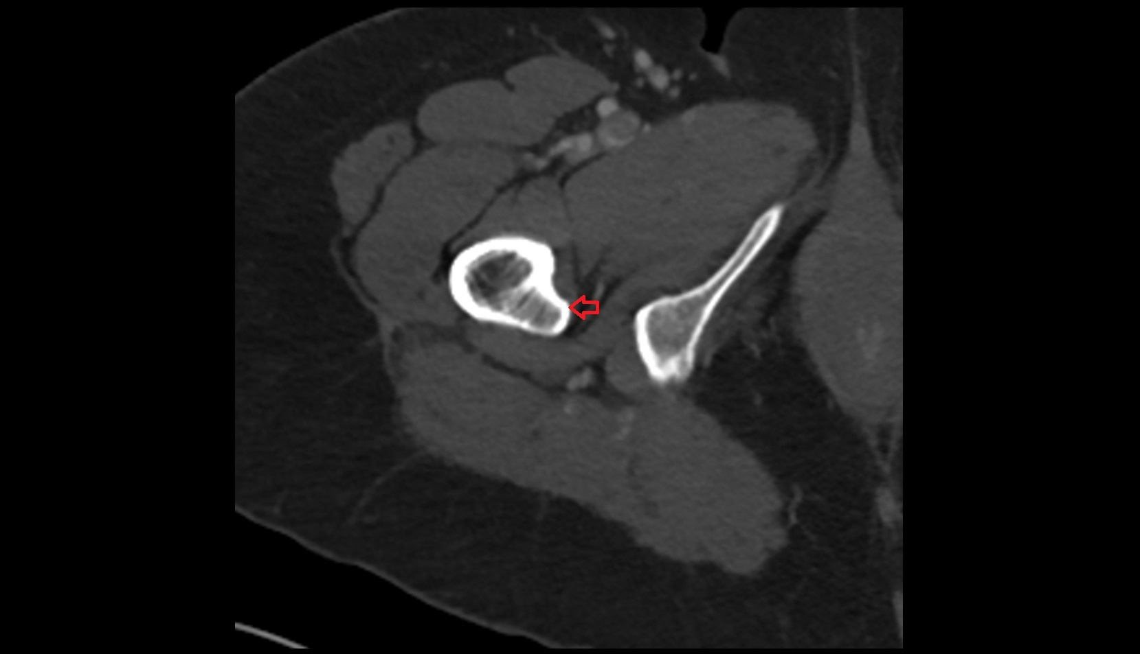 lesser trochanter ct axial image