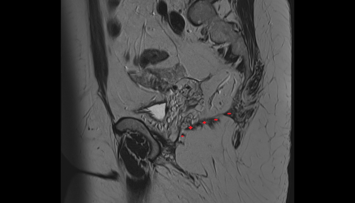 levator ani muscle  MRI  SAGITTAL  anatomy  image-img-00000-00000