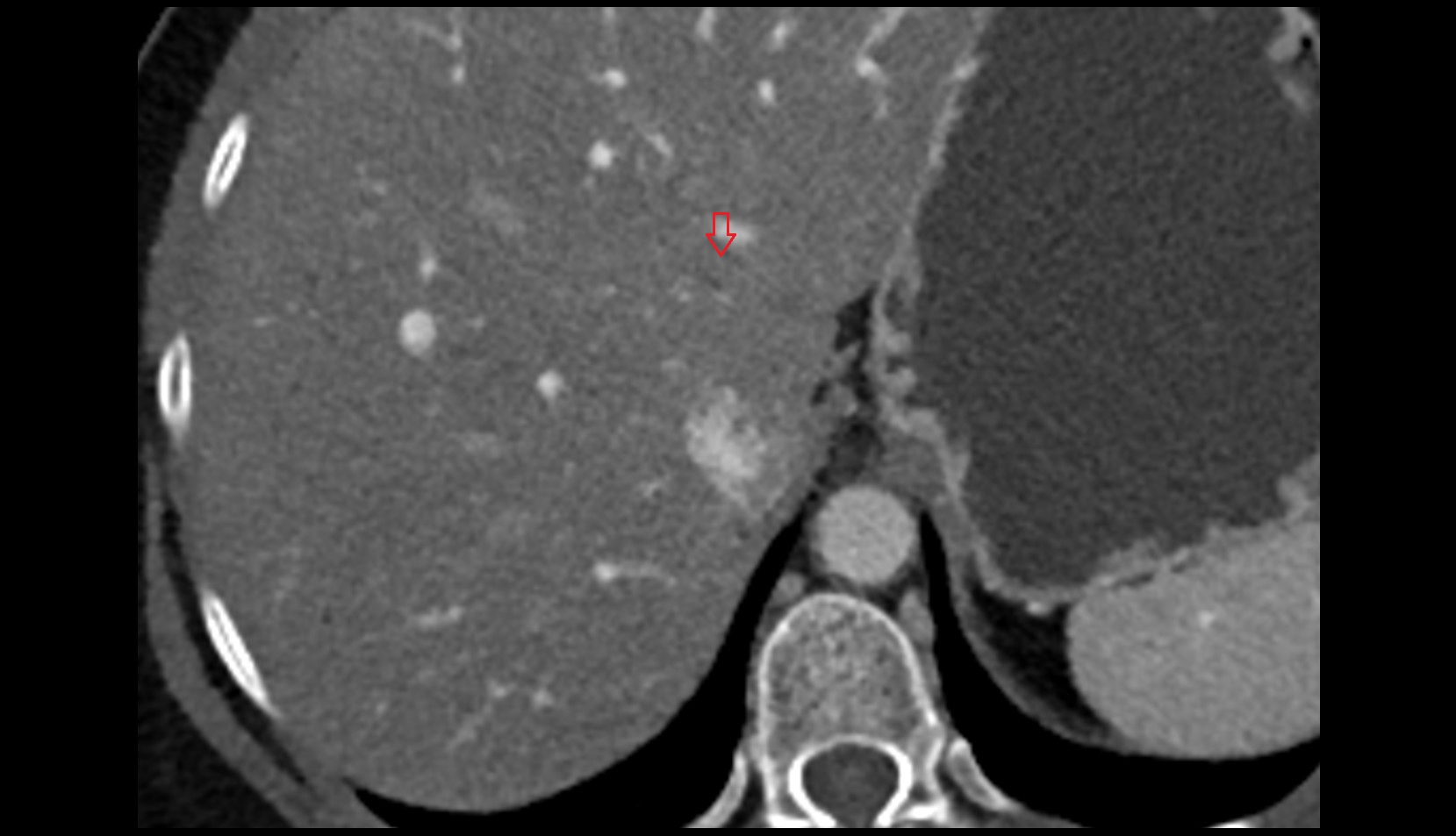 ligamentum venosum CT axial image 0