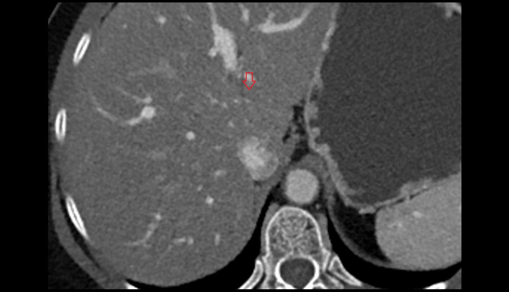ligamentum venosum CT axial image 1