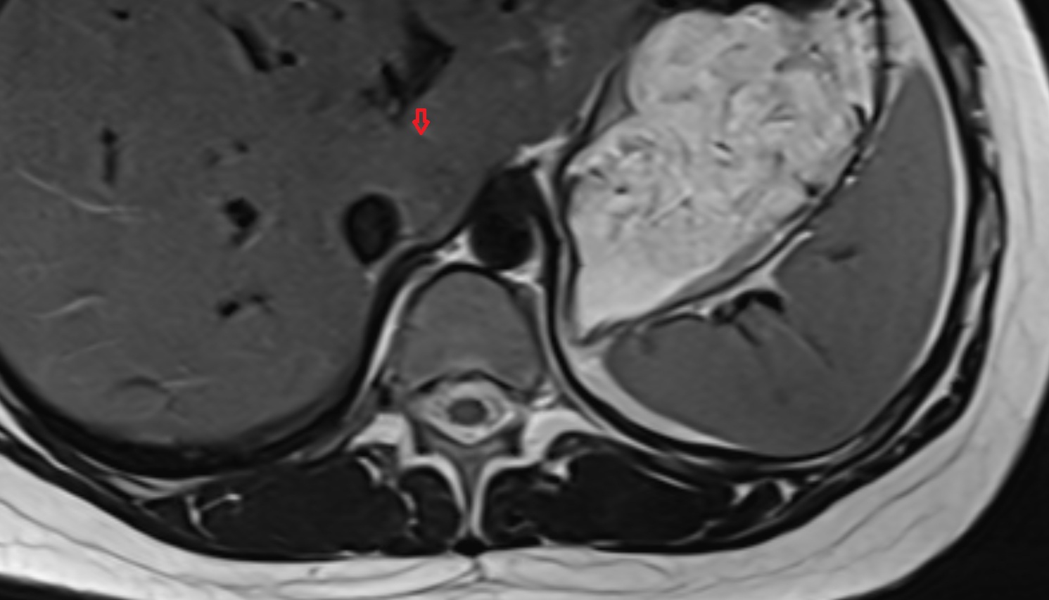 ligamentum venosum MRI axial  anatomy  image -img-00000-00000