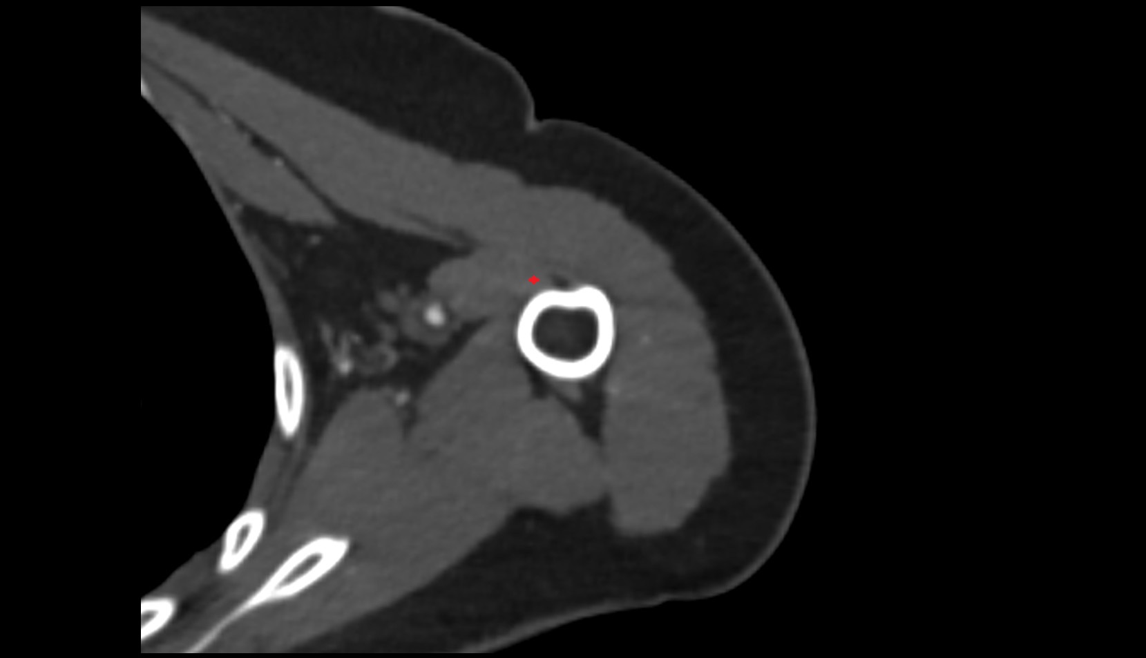 long head  of biceps brachii muscle CT axial
