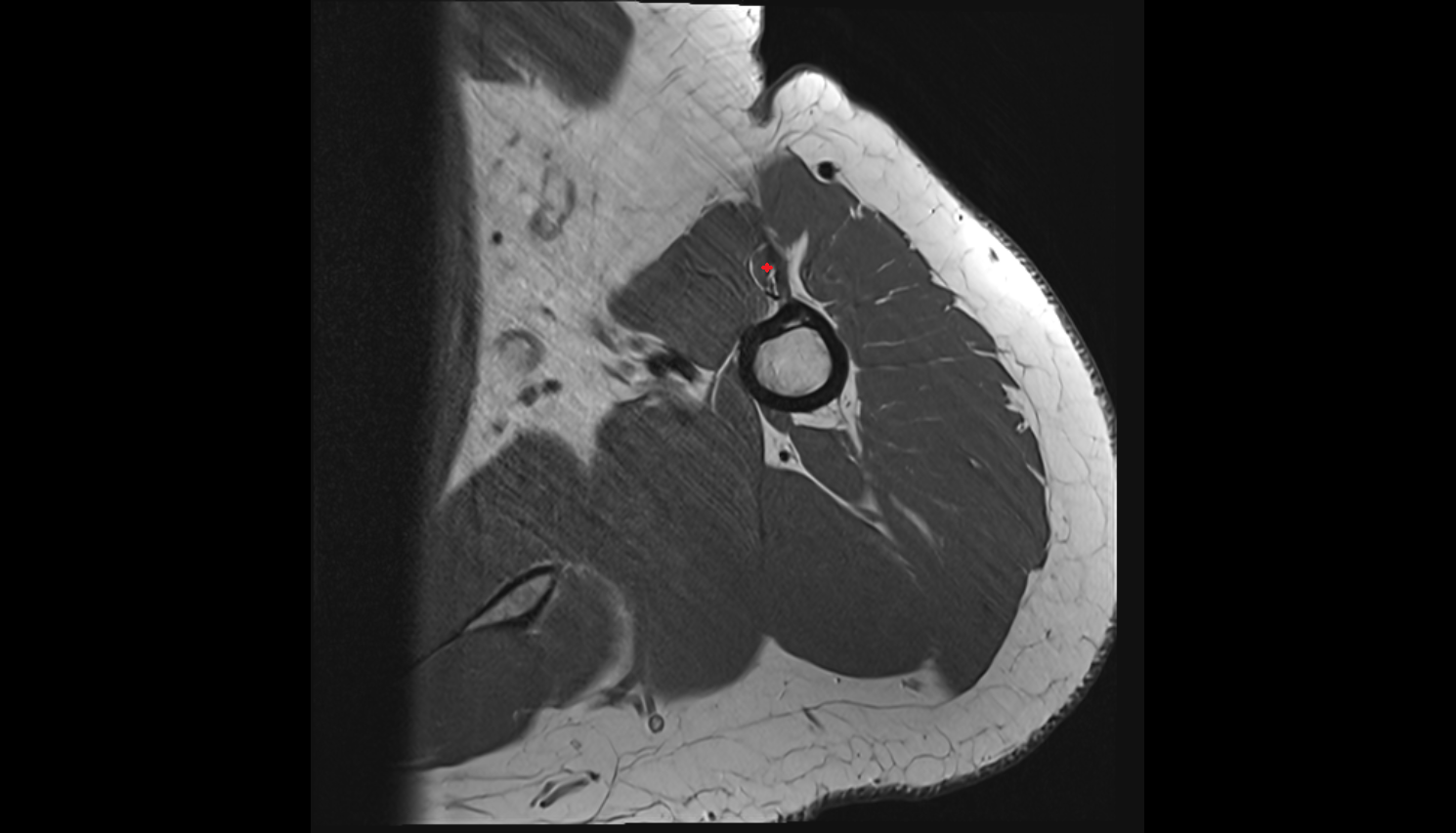 long head of biceps brachii muscle axial cross sectional anatomy 3T MRI AI enhanced radiology image-img-00000-00000