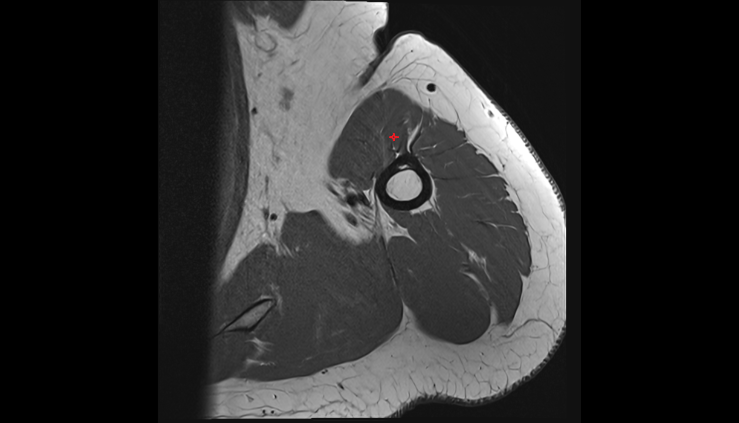 long head of biceps brachii muscle axial cross sectional anatomy 3T MRI AI enhanced radiology image-img-00000-00000_00001