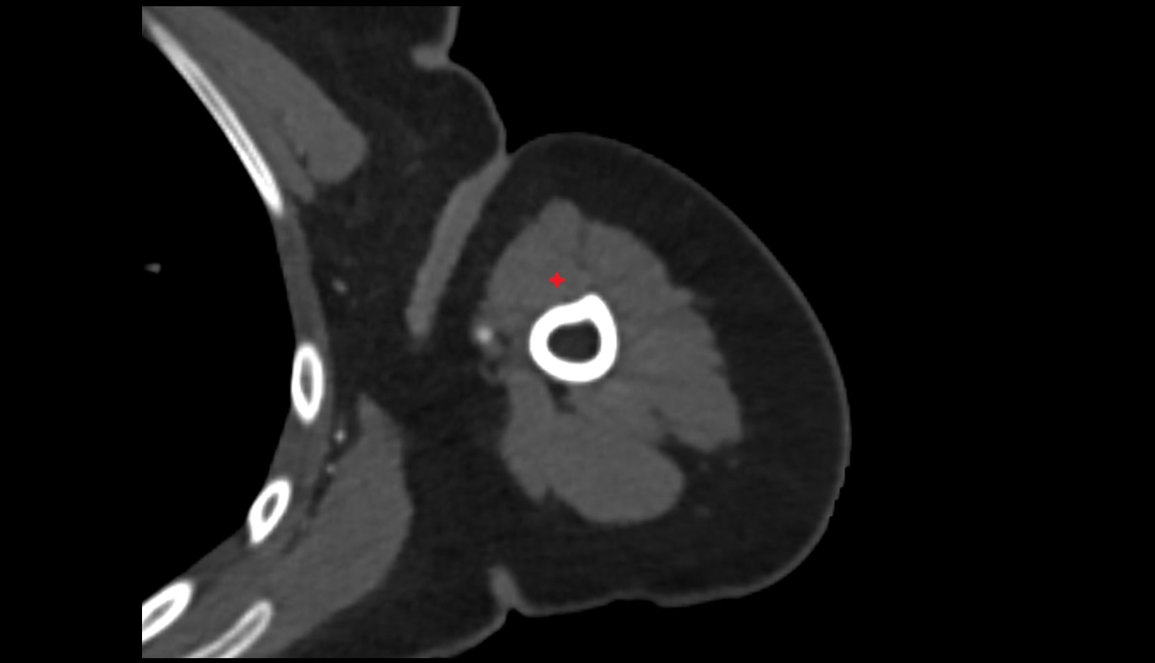 long head of biceps brachii muscle ct
