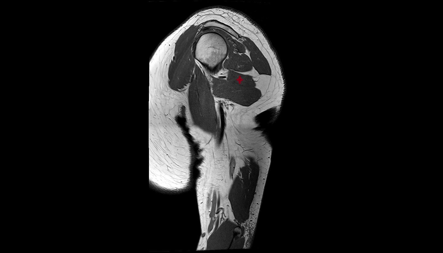 long head of triceps brachii muscle axial cross sectional anatomy 3T MRI AI enhanced radiology image-img-00000-00000_00001