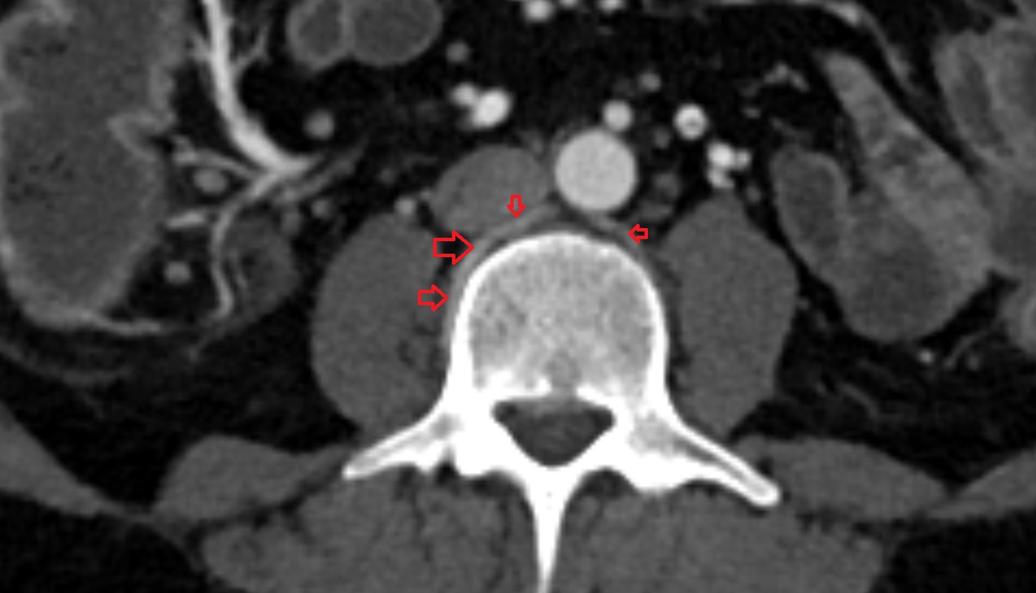 lumbar artery  ct axial  anatomy  image-img-00000-00000