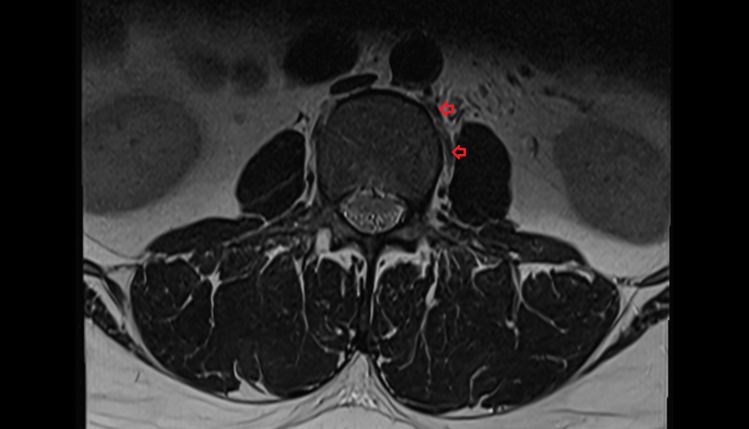 lumbar artery  mri axial  anatomy  image-img-00000-00000