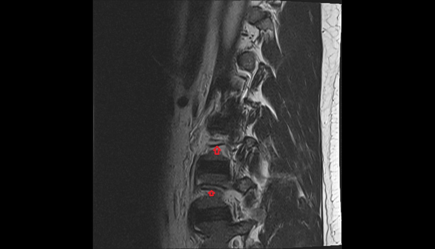 lumbar artery  mri sagittal  anatomy  image-img-00000-00000