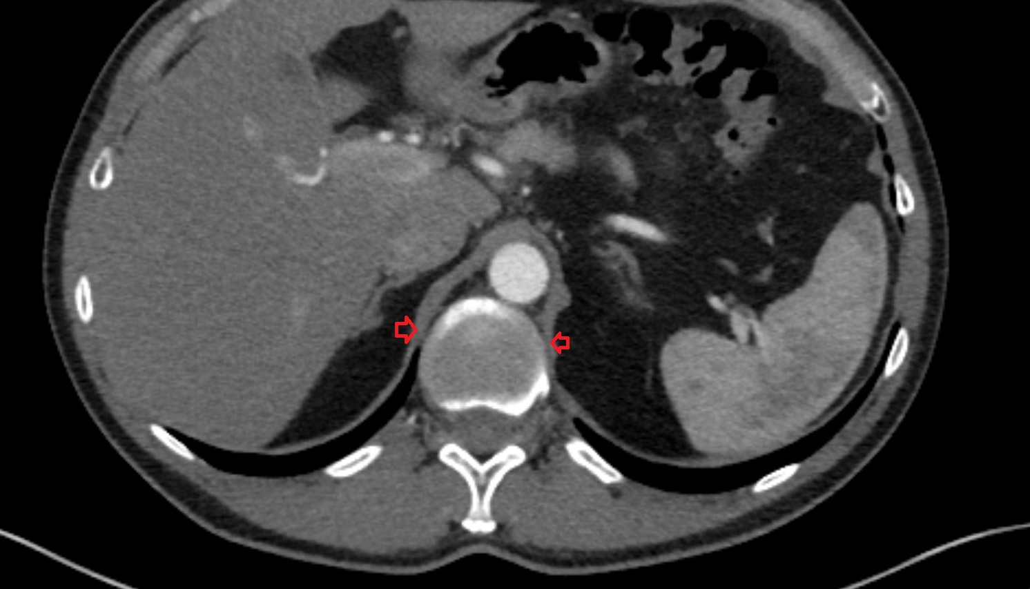 lumbar part of diaphragm CT axial  image -img-00000-00000