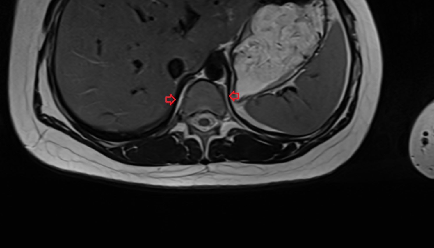 lumbar part of diaphragm MRI axial  image -img-00000-00000