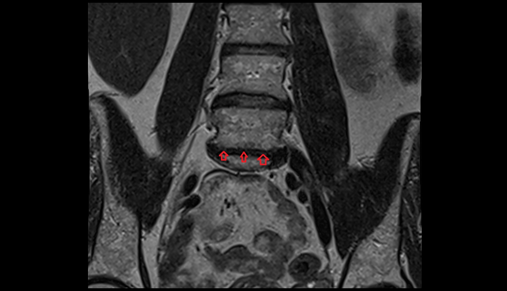 lumbosacral joint CORONAL MRI