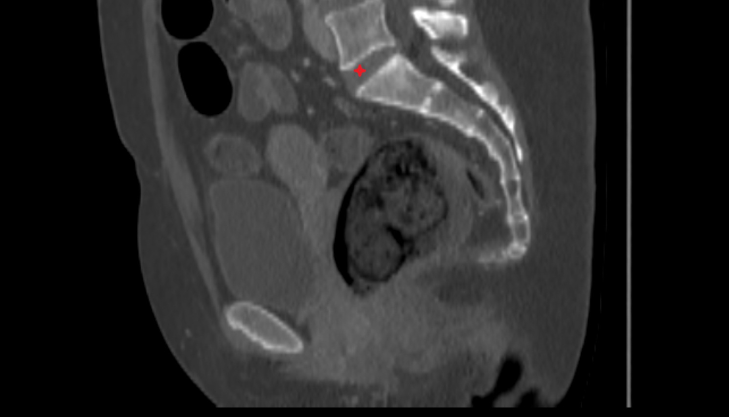 lumbosacral joint CT SAG anatomy  image-img-00000-00000