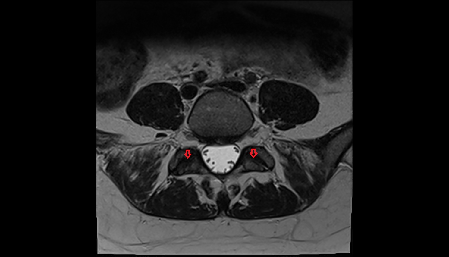 lumbosacral joint ari axial  anatomy  image-img-00000-00000