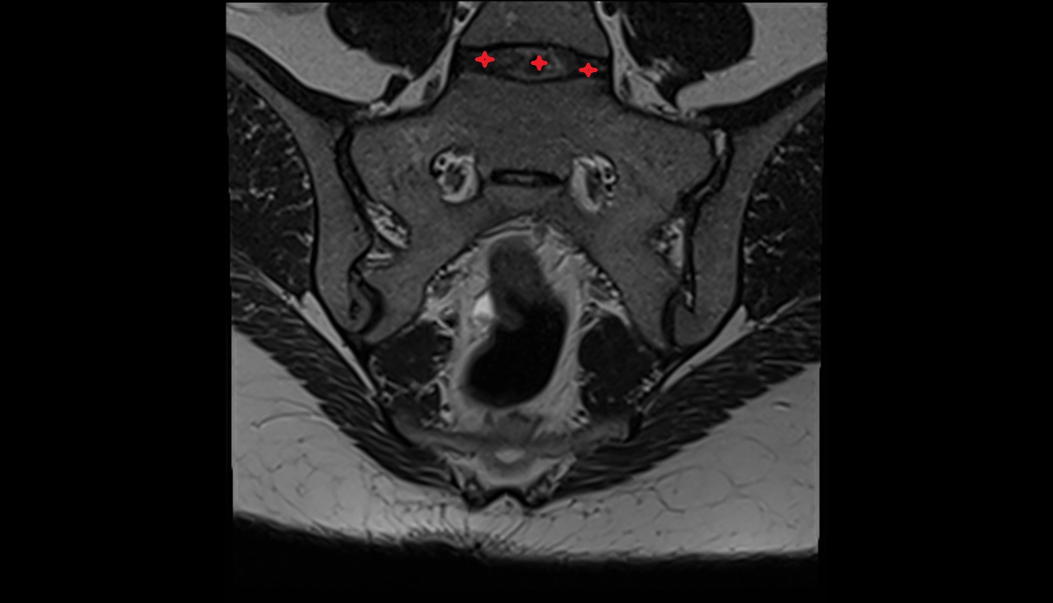 lumbosacral joint ari axial  anatomy  image-img-00000-00000_00001