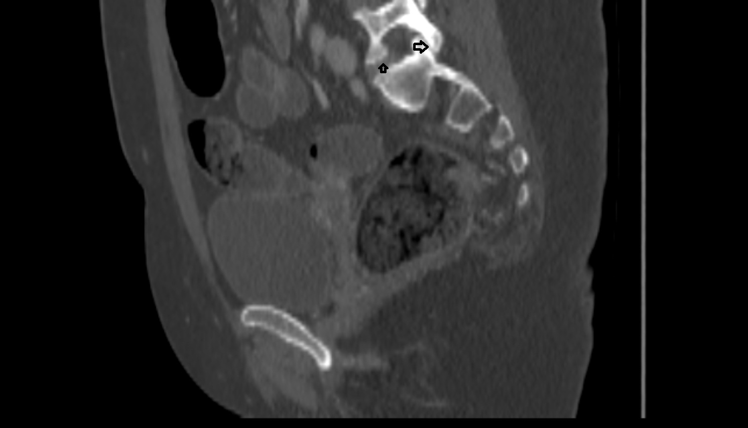 lumbosacral joint ct sag  anatomy  image-img-00000-00000