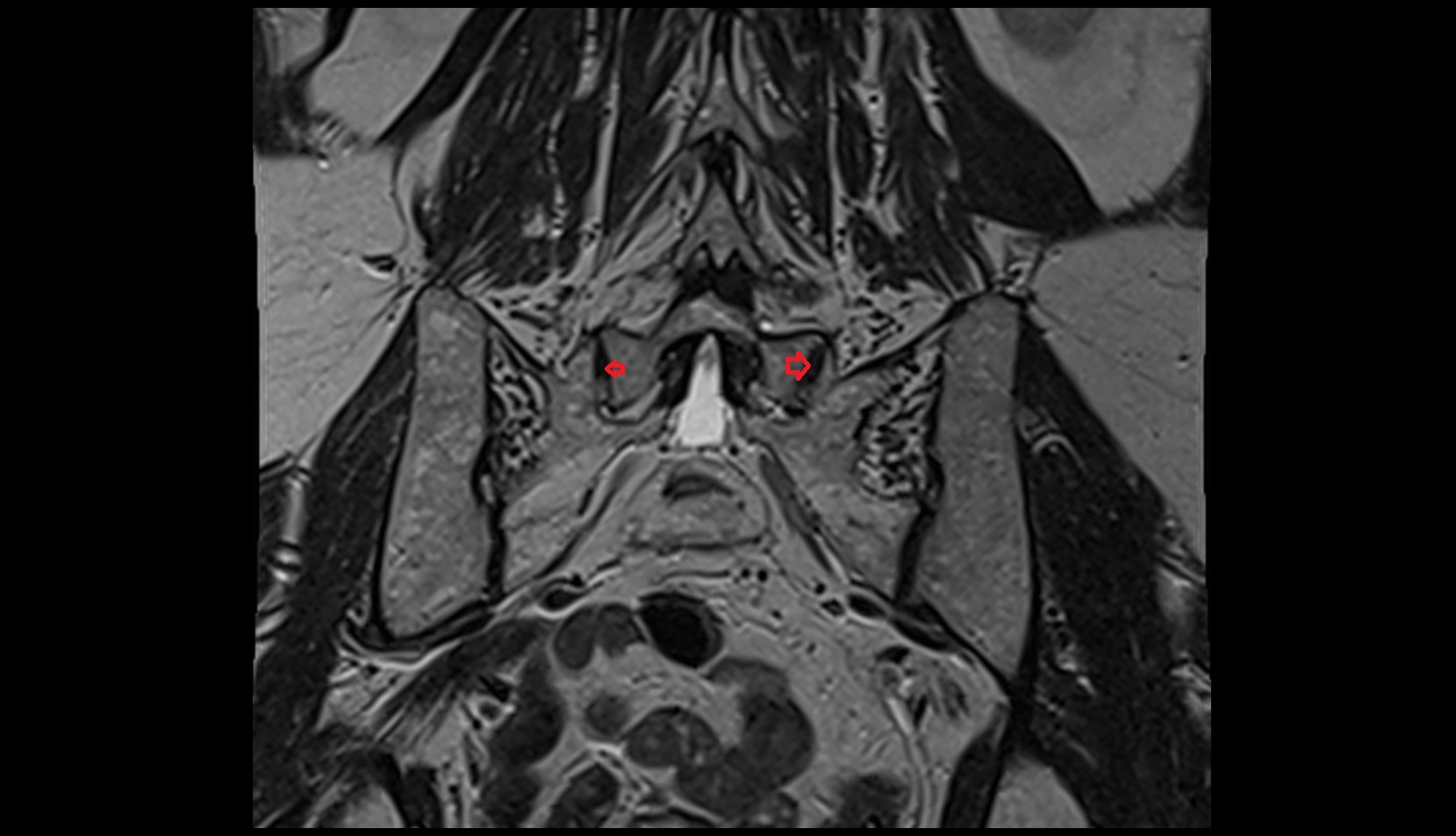 lumbosacral joint mri coronal image