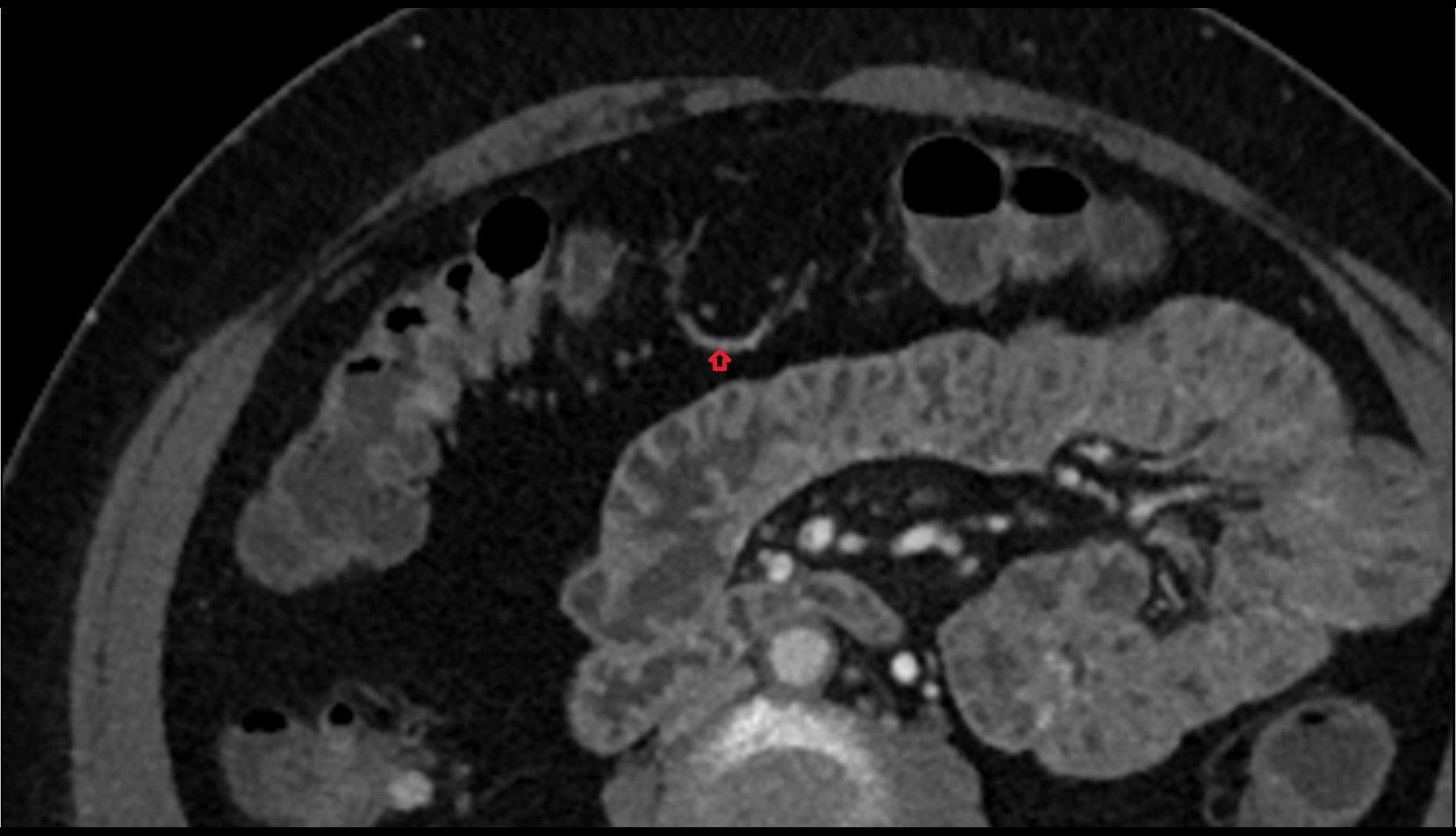 marginal artery of Drummond CT axial  image