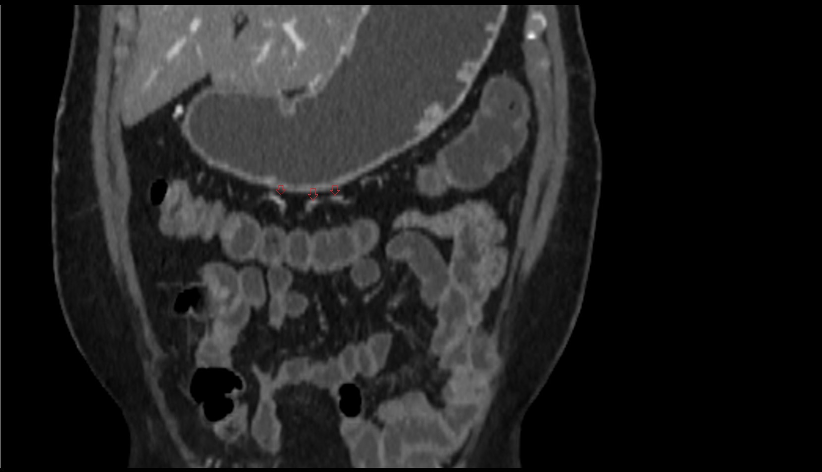 marginal artery of Drummond CT coronal image