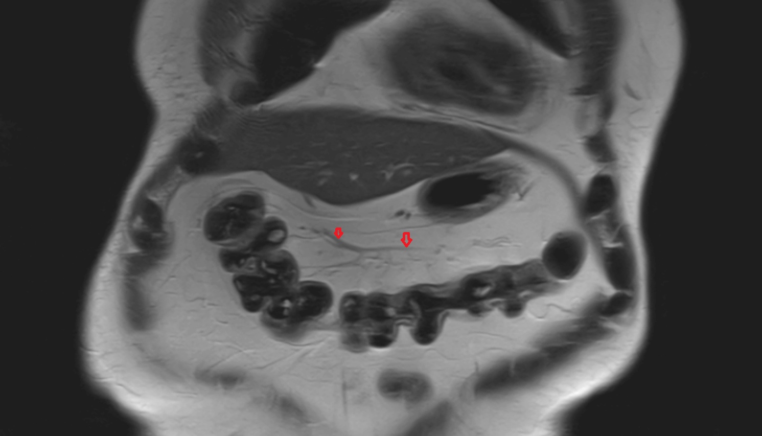 marginal artery of Drummond  MRI coronal anatomy  image -img-00000-00000