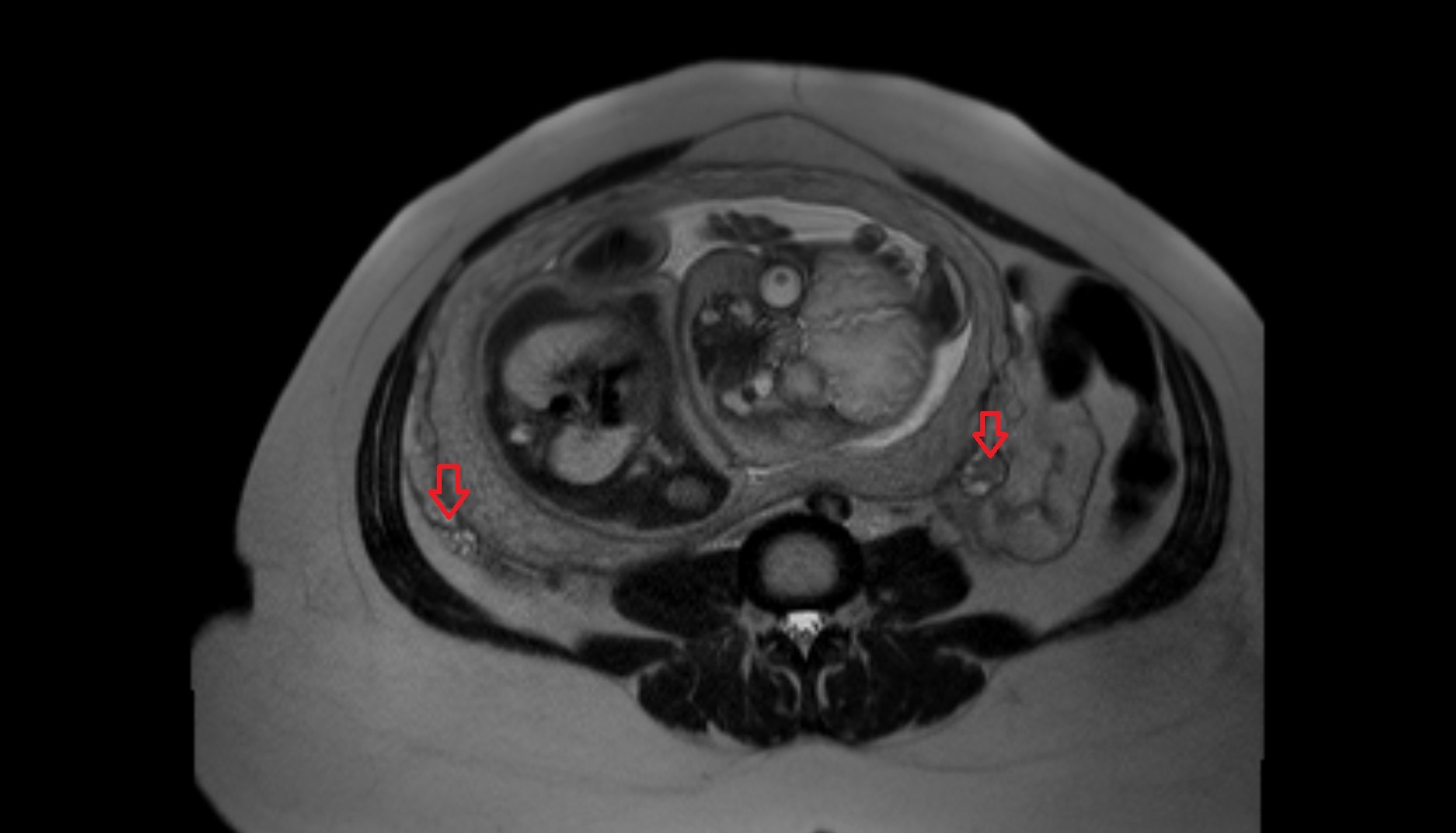 maternal ovaries  MRI coronal  anatomy image-img-00000-00000