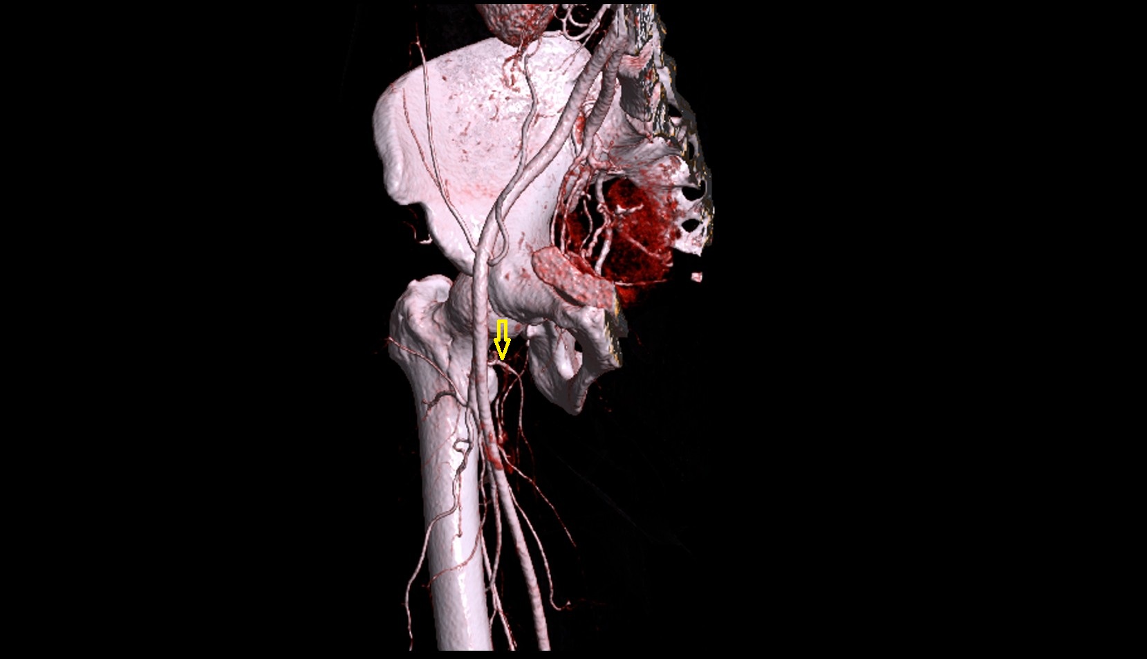 medial circumflex femoral artery  CT 3D VRT anatomy image