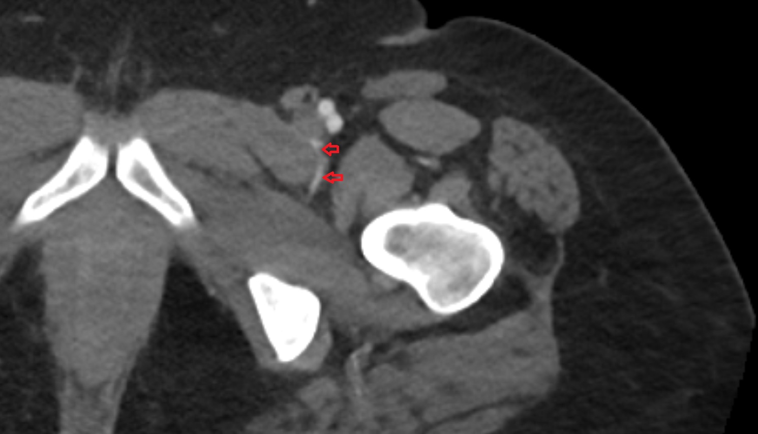 medial circumflex femoral artery  MRI  axial  anatomy  image-img-00000-00000