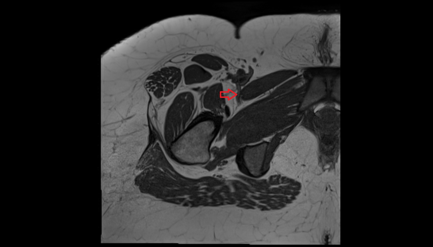 medial circumflex femoral artery MRI axial image  MRI  axial  anatomy  image-img-00000-00000