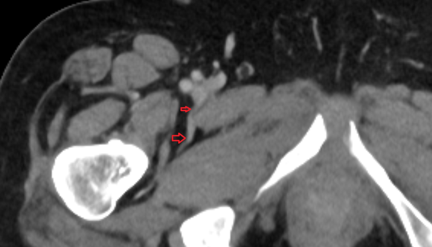 medial circumflex femoral vein  CT axial  anatomy  image-img-00000-00000