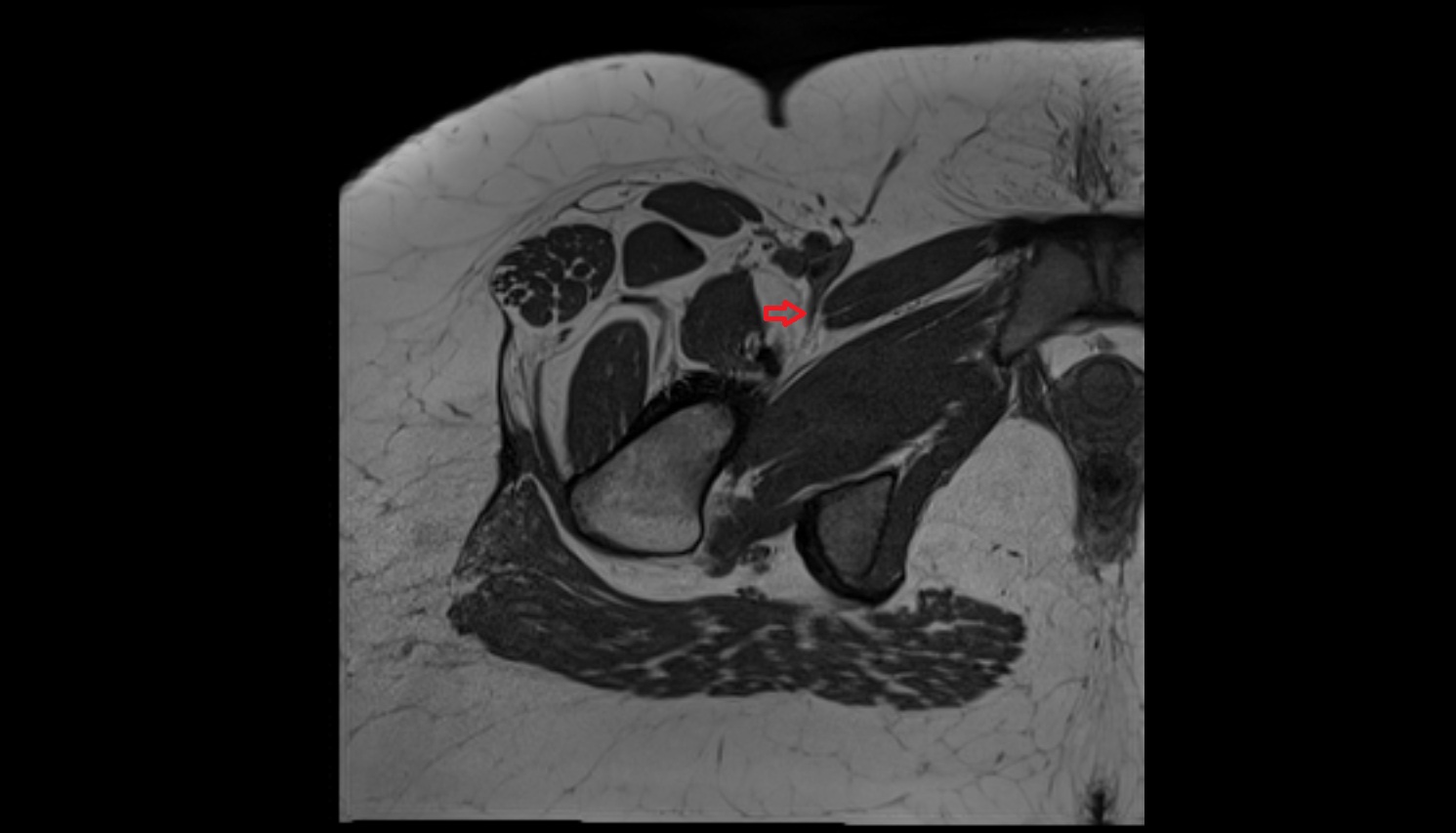 medial circumflex femoral vein  mri axial  anatomy  image-img-00000-00000