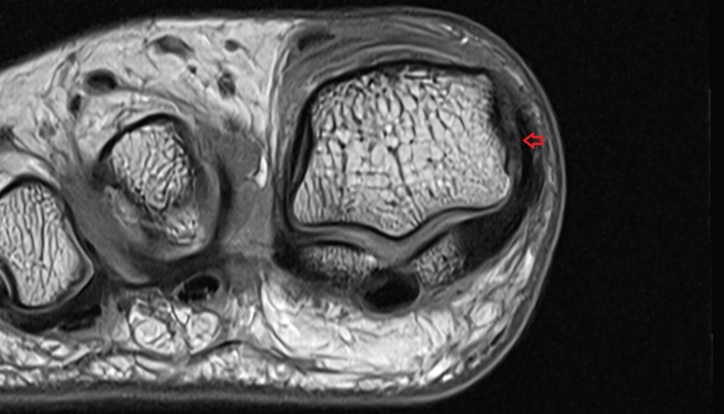 medial collateral ligament of big toe (medial metatarsophalangeal collateral ligament)  axial cross sectional anatomy 3T MRI AI enhanced radiology image-img-00000-00000