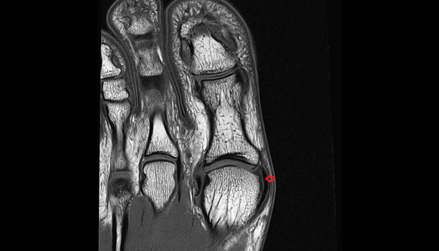 medial collateral ligament of big toe (medial metatarsophalangeal collateral ligament)  axial cross sectional anatomy 3T MRI AI enhanced radiology image-img-00000-00000_00001