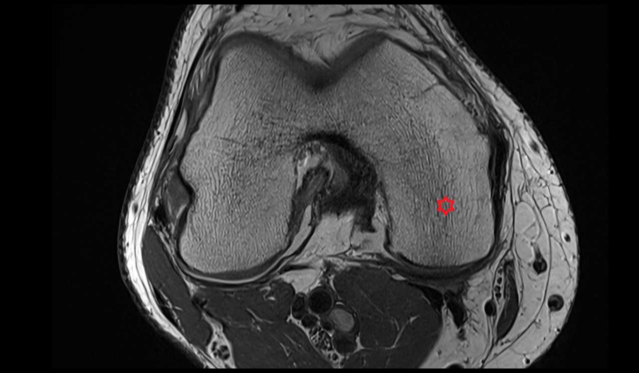 medial condyle of the femur anatomy