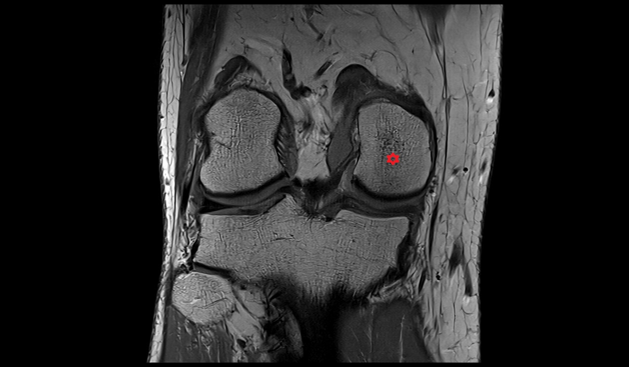 medial condyle of the femur anatomy 3t mri