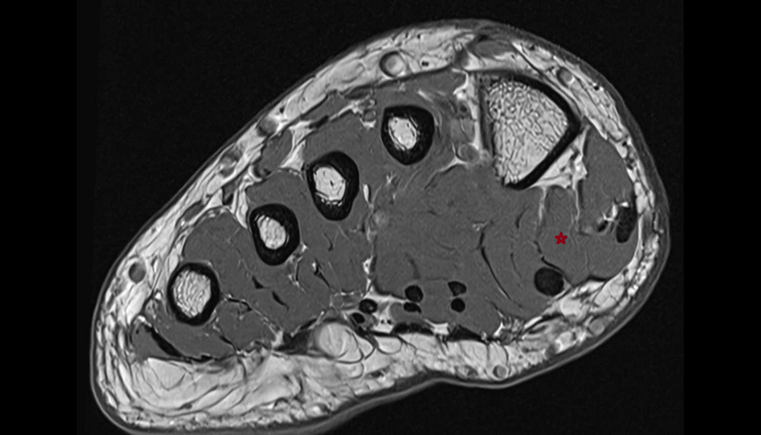 medial head of flexor hallucis brevis muscle axial cross sectional anatomy 3T MRI AI enhanced radiology image-img-00000-00000