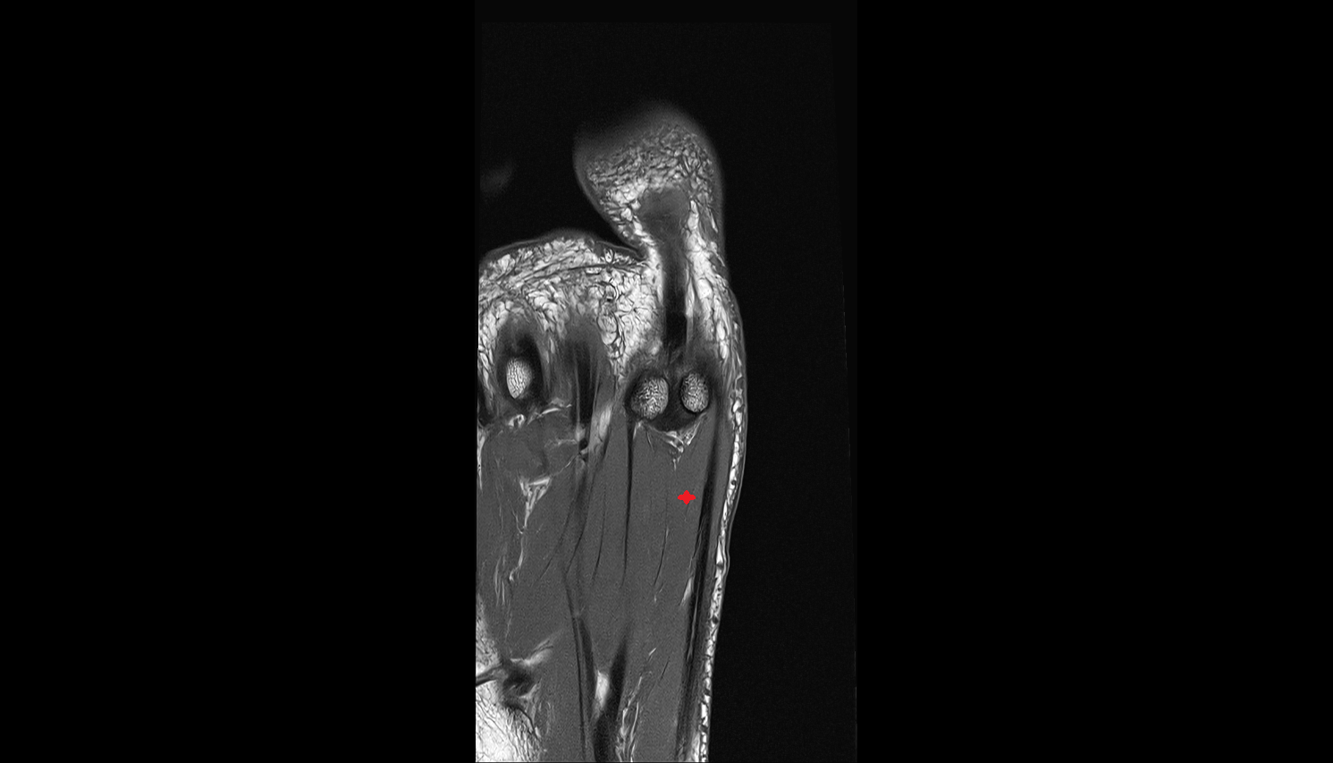 medial head of flexor hallucis brevis muscle coronal cross sectional anatomy 3T MRI AI enhanced radiology image-img-00000-00000_00001