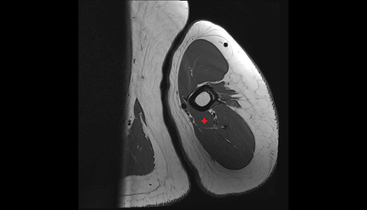 medial head of triceps brachii muscle  axial cross sectional anatomy 3T MRI AI enhanced radiology image-img-00000-00000_00001
